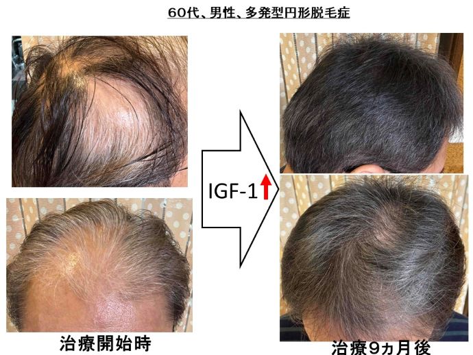 円形脱毛症　病院